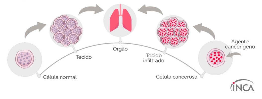 Processo de formação do câncer - da célula normal ao tecido infiltrado