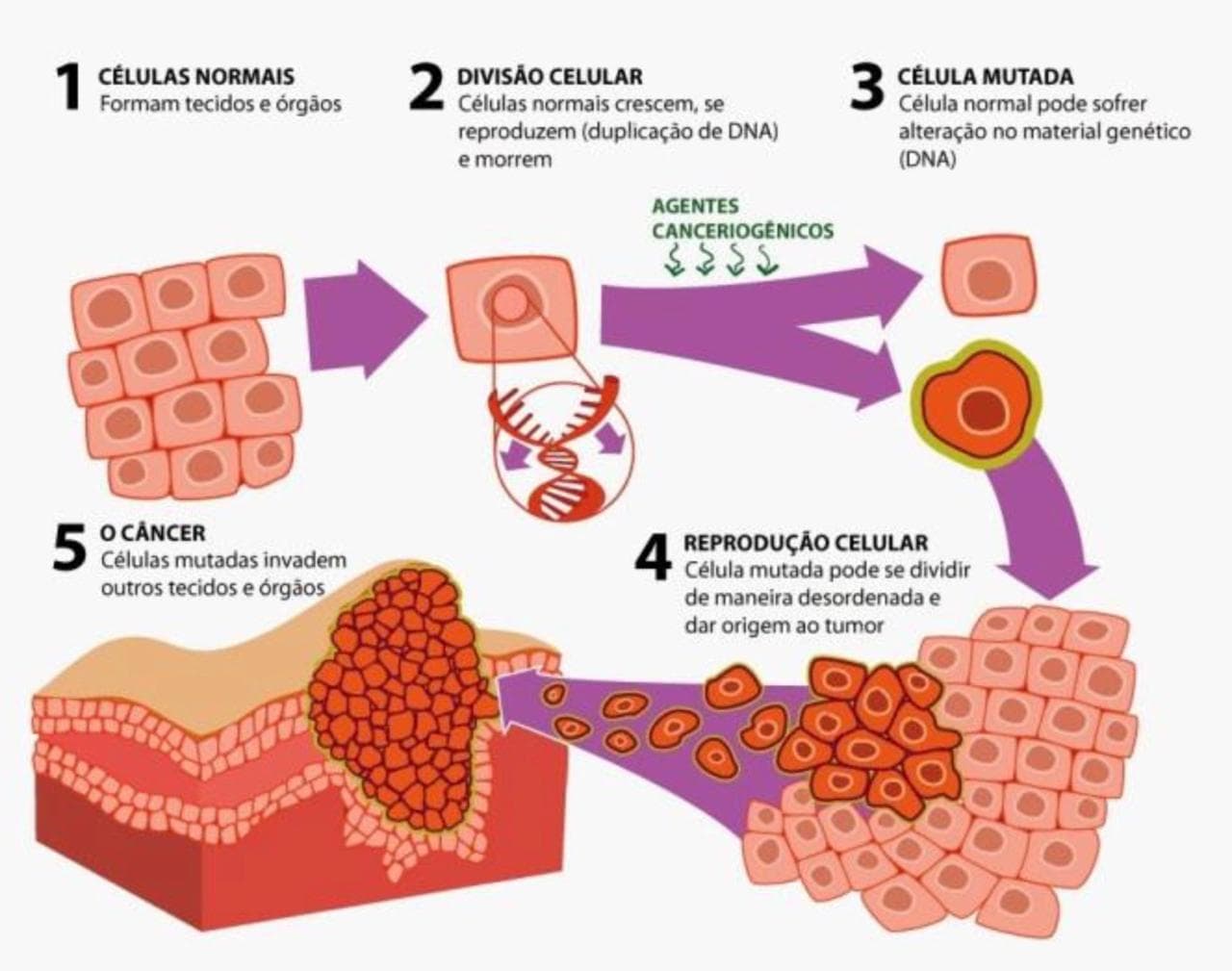 Etapas do desenvolvimento do câncer - células normais e formação do tumor